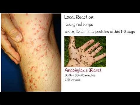 are fire ant bites similar to poison ivy